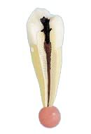 NMD Nexus Medodent Dental 5 Stage Endodontic Demonstration & Educational Model (Pack Of 1Pcs)