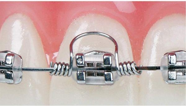 Dental Orthodontic Torque Spring (16*22 Big ) (Pack Of 10Pcs)