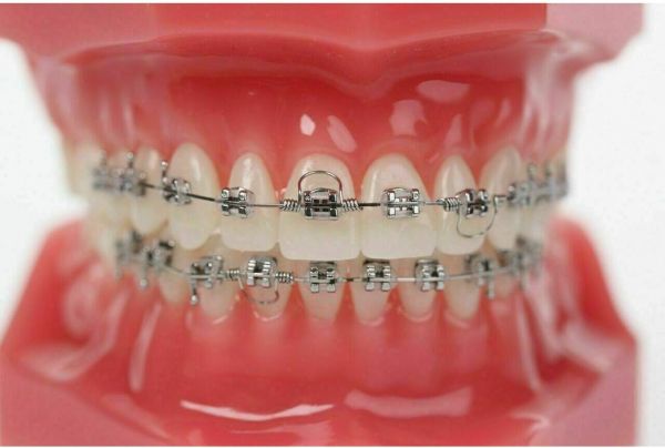 Dental Orthodontic Torque Spring (16*22 Big ) (Pack Of 10Pcs)
