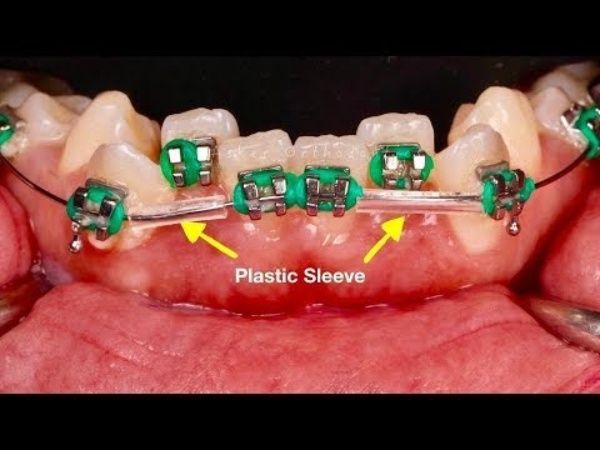  Dental Archwire Sleeve (1pc/pk)