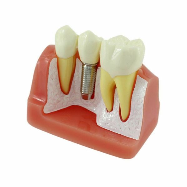 NMD Nexus Medodant  Dental Implant With Bridge Educational Model