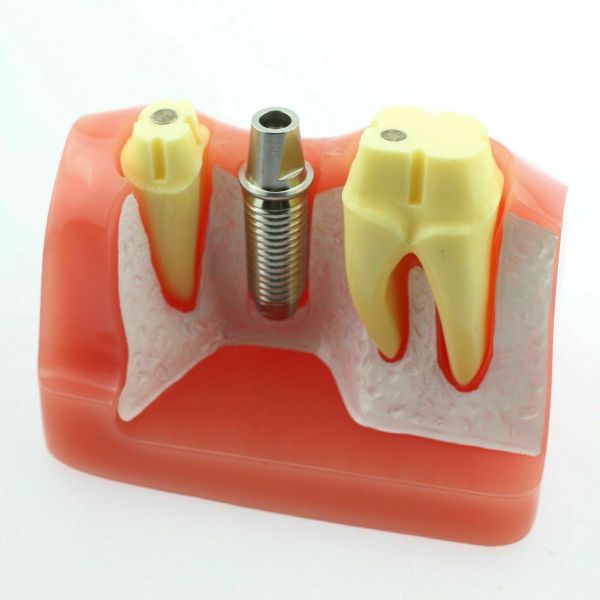 NMD Nexus Medodant  Dental Implant With Bridge Educational Model