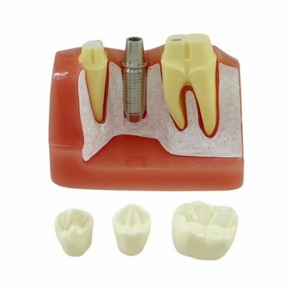 NMD Nexus Medodant  Dental Implant With Bridge Educational Model