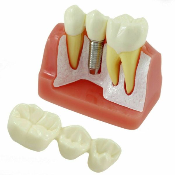 NMD Nexus Medodant  Dental Implant With Bridge Educational Model