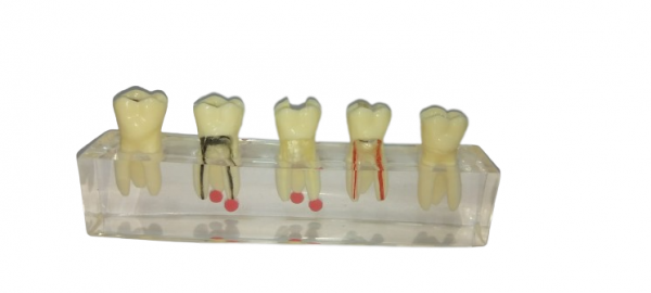 NMD Nexus Medodent Dental Endodontic Demonstration Root Treatment Model with Removable Crown (Pack Of 1 Pcs)