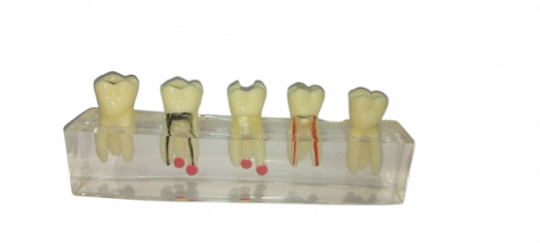 NMD Nexus Medodent Dental Endodontic Demonstration Root Treatment Model with Removable Crown (Pack Of 1 Pcs)