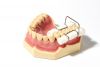 NMD DENTAL STAINLESS STEEL COTTON ROLL HOLDER (4PCS/PACK)