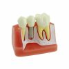 NMD Dental Implant With Bridge Educational Model